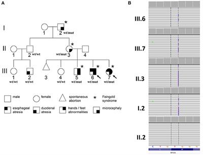 Occurrence of Esophageal Atresia With Tracheoesophageal Fistula in Siblings From Three-Generation Family Affected by Variable Expressivity MYCN Mutation: A Case Report